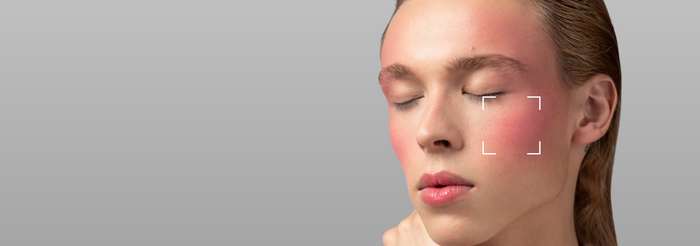 Sensitive Skin