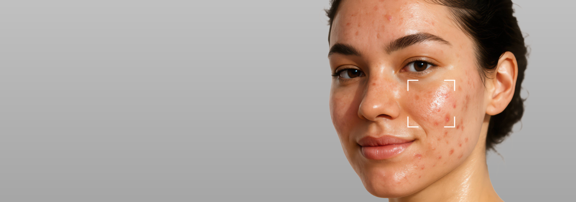 Acne Prone Skin