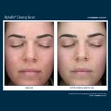 AlphaRet Clearing Serum